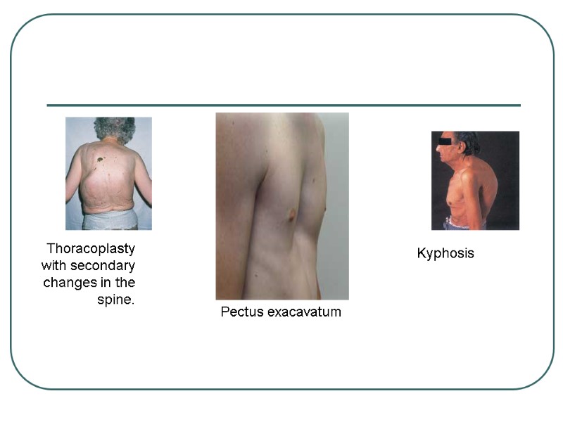 Kyphosis  Thoracoplasty with secondary changes in the spine.  Pectus exacavatum